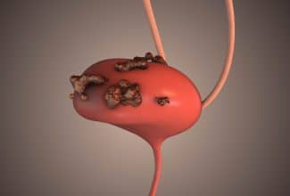 Cáncer de la vejiga: síntomas y factores de riesgo