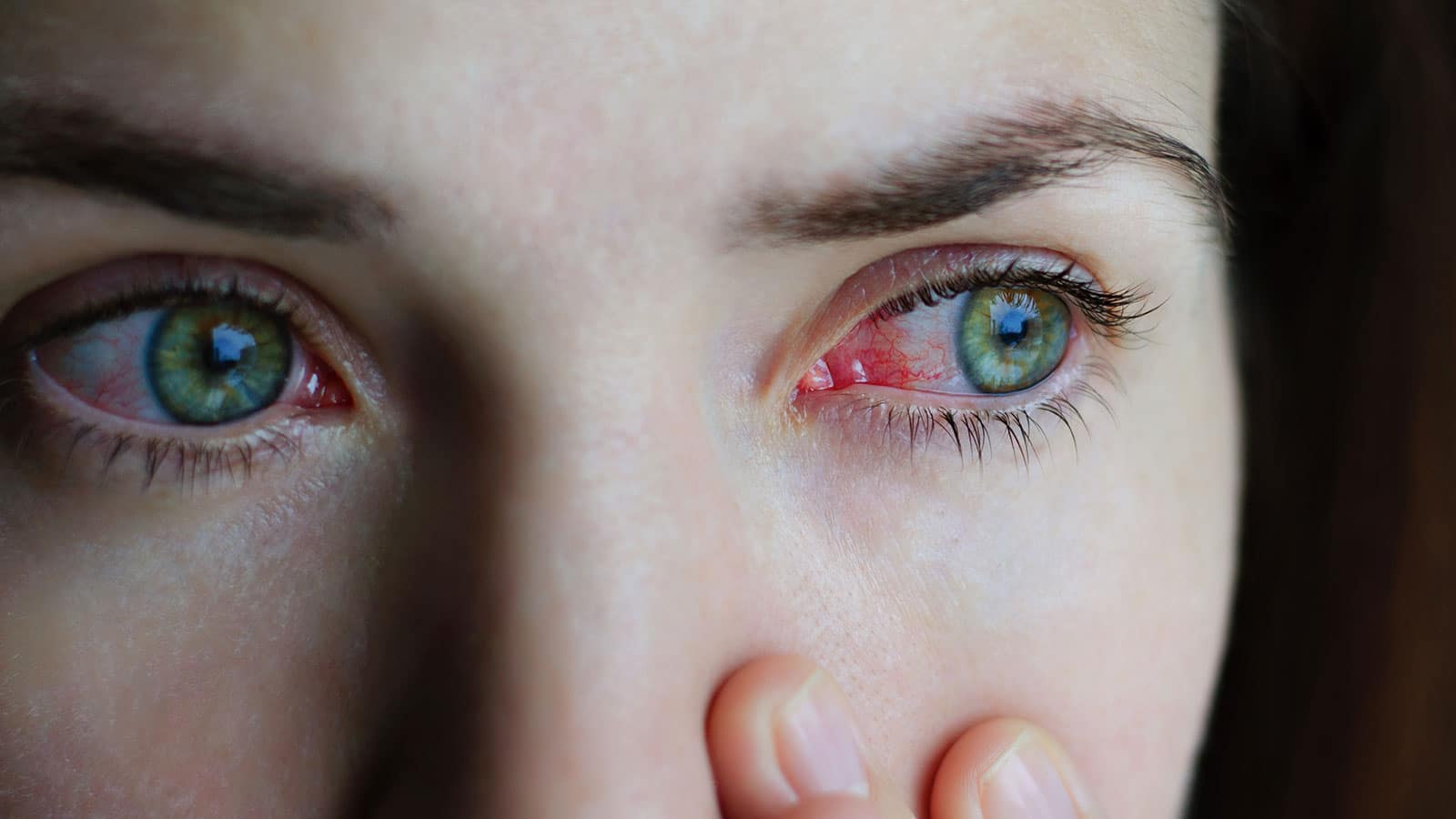 conjutivitis