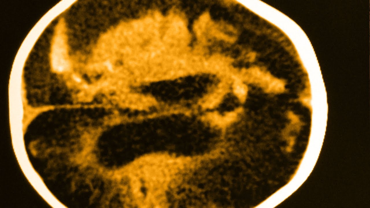 imagen-infarto-cerebral