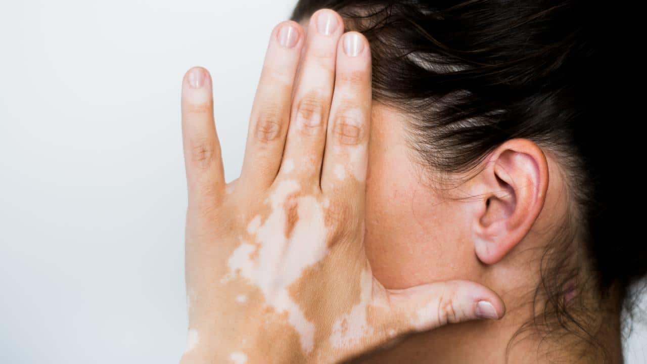 El vitiligo, una enfermedad aún muy desconocida y estigmatizante