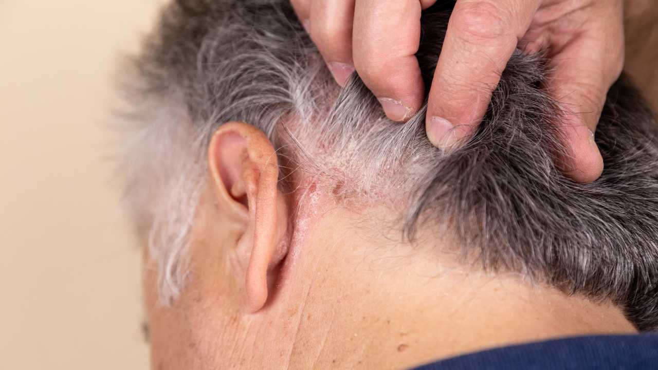¿Quieres saber más sobre la psoriasis?