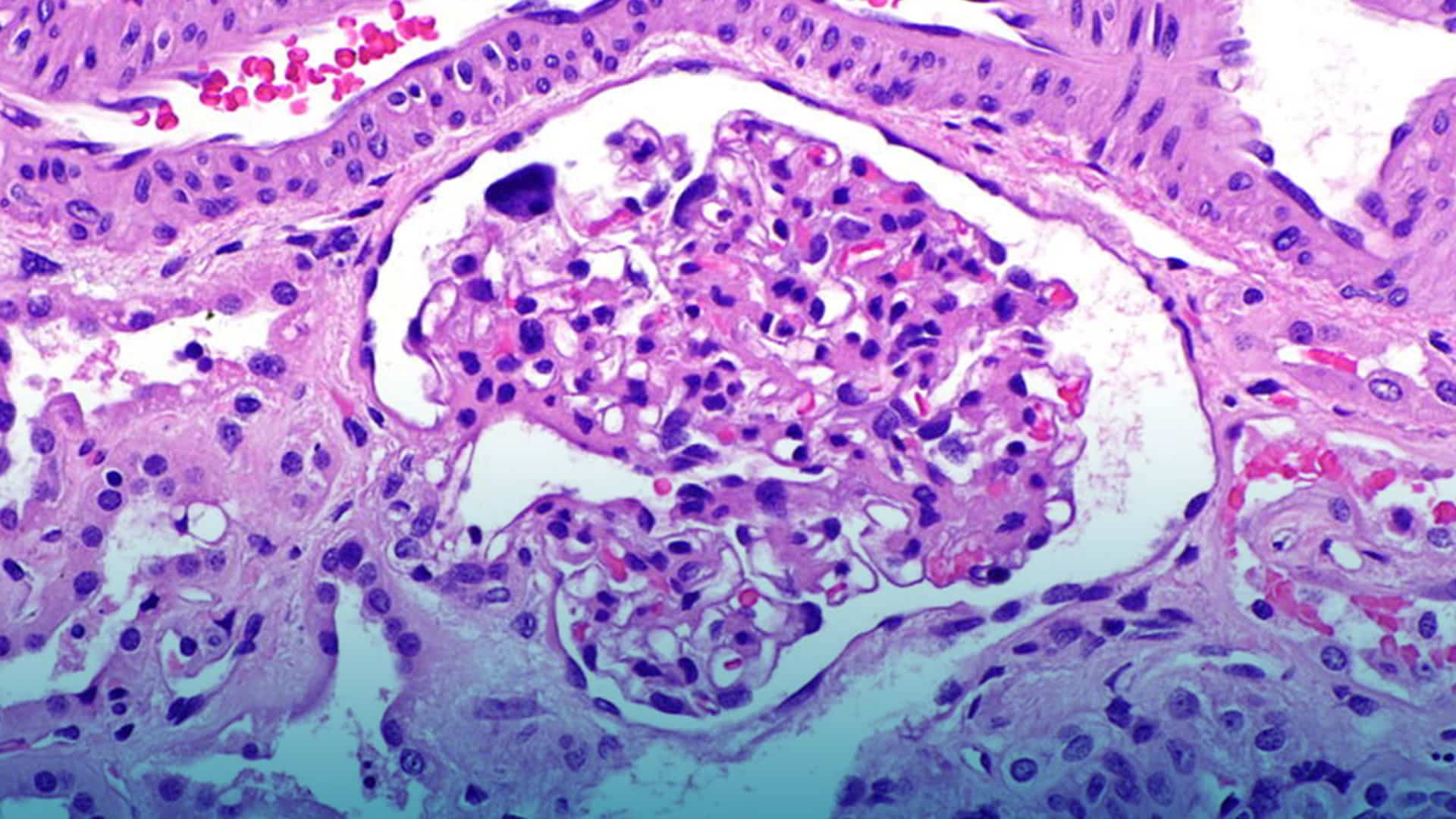 Cistinosis, el testimonio de una madre