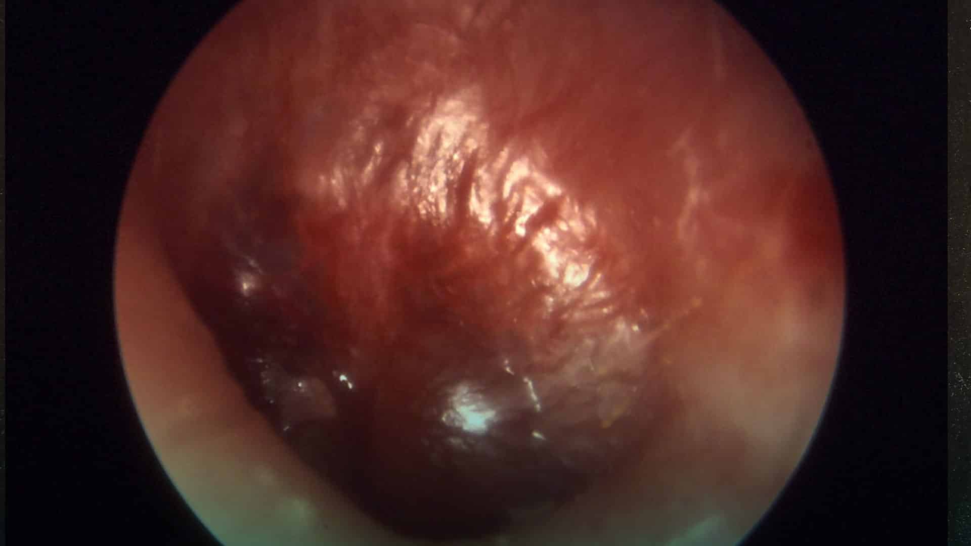 Otitis media