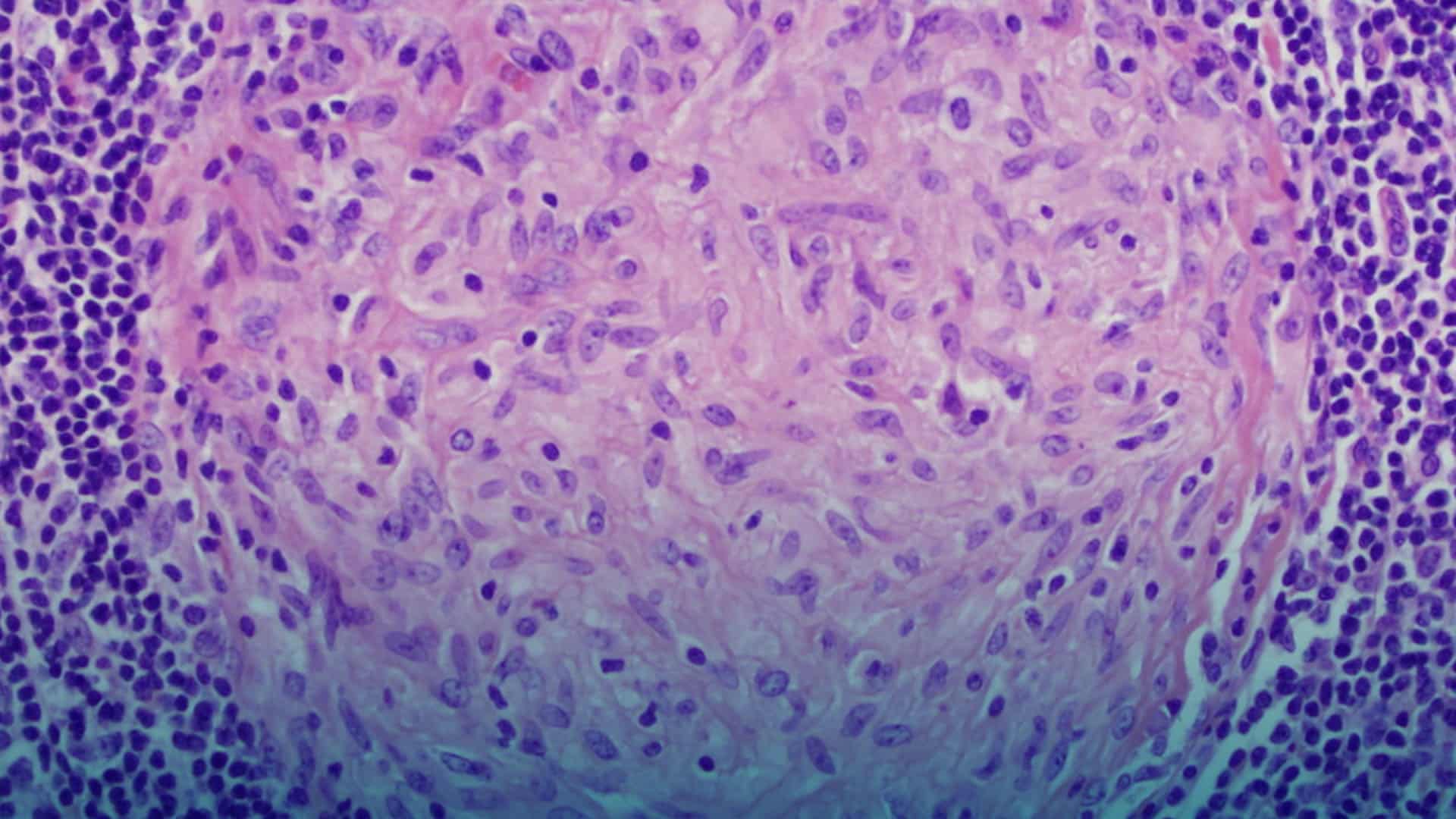 Granuloma del embarazo