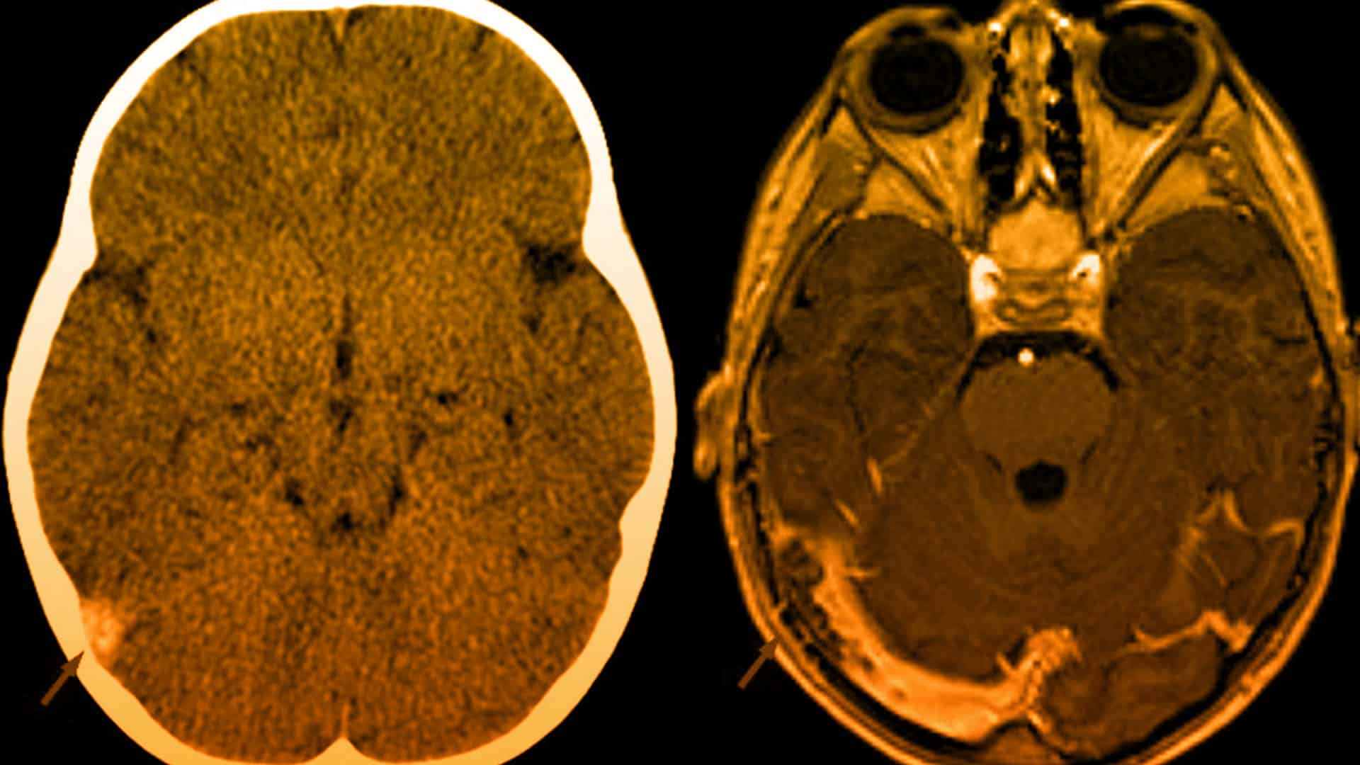 Trombosis cerebral en el embarazo