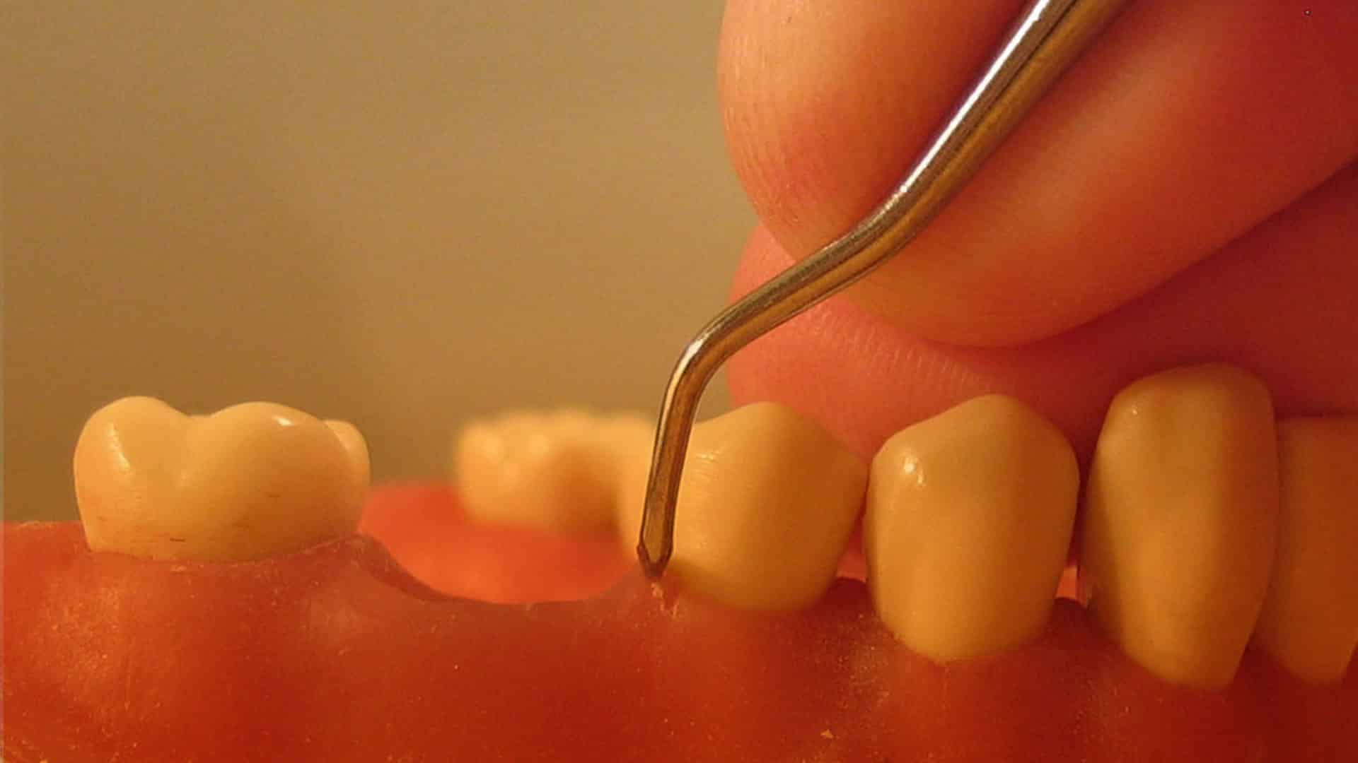 Gingivitis durante el embarazo