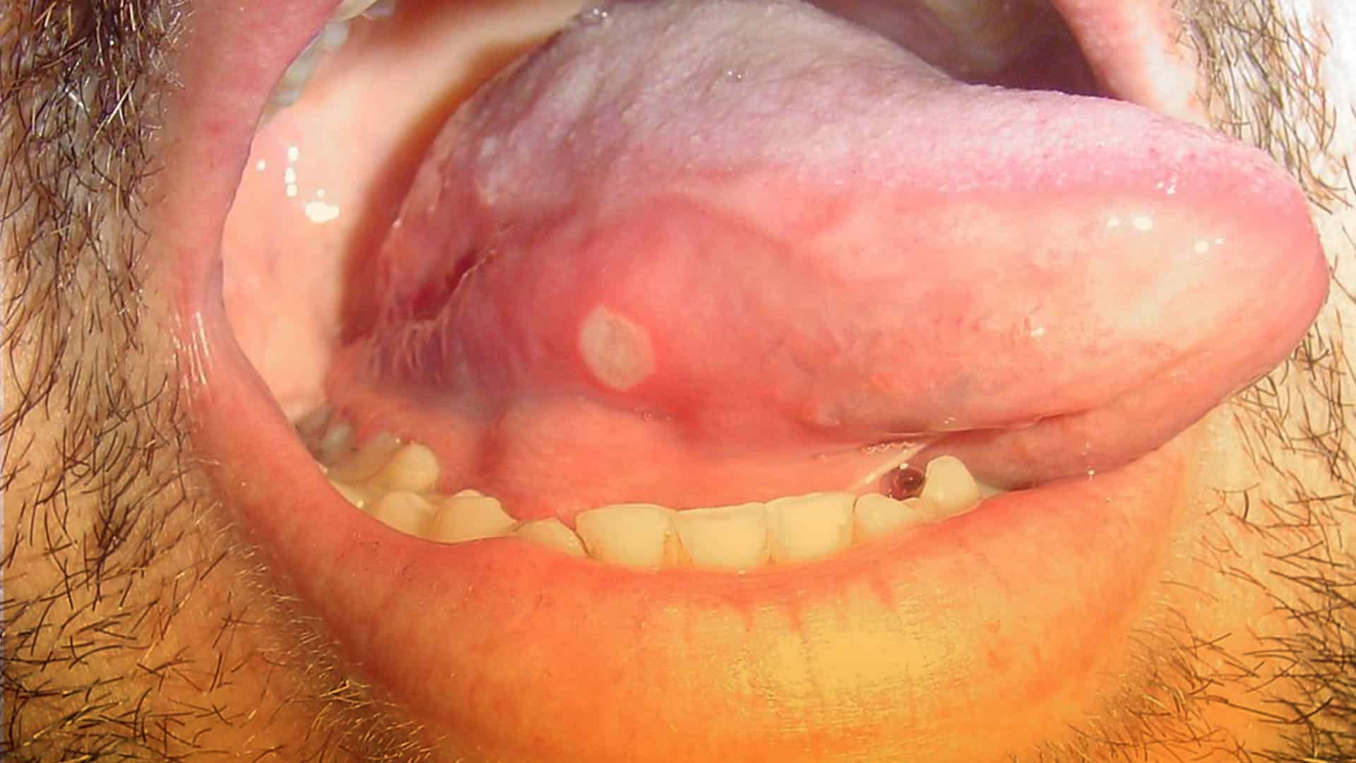 Diferencias entre aftas y herpes