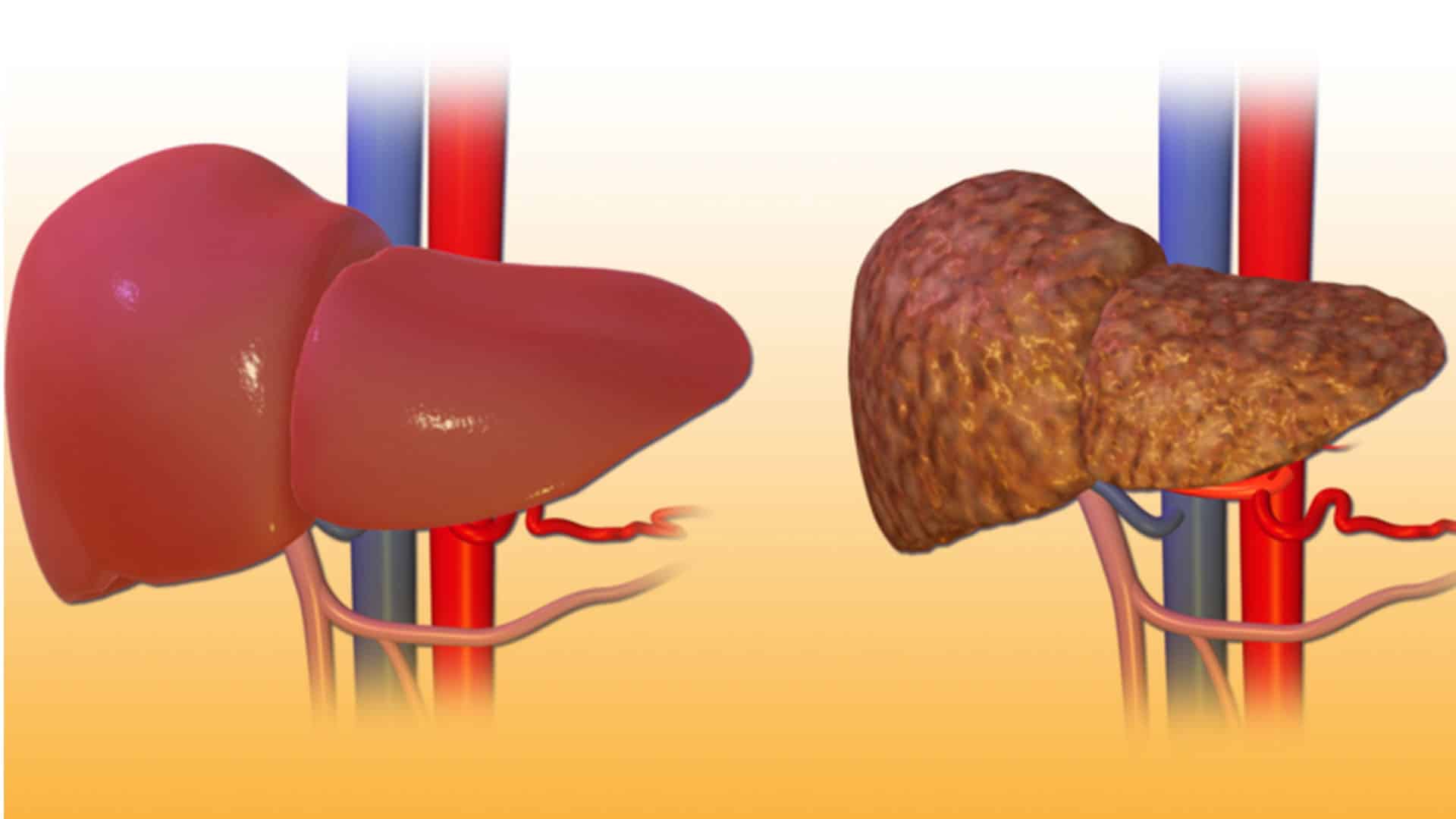 Cirrosis hepática
