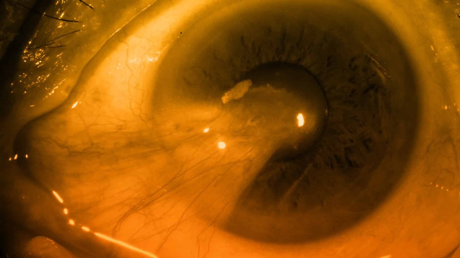 Nuevo dispositivo portátil para cortar la catarata