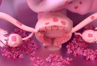 ilustración médica sobre endometriosis y sus síntomas