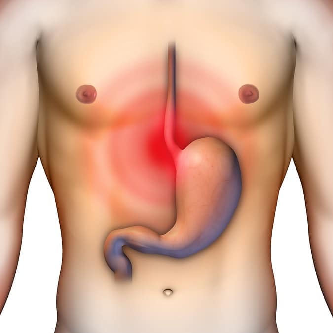 cáncer de esófago