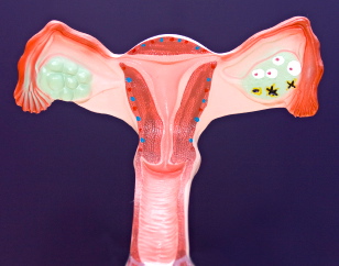 cáncer de endometrio