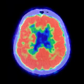 ¿Psicoterapia o medicamentos para la depresión? Un escáner del cerebro tiene la respuesta