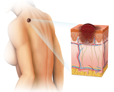 Llega Zelboraf: una medicina nueva contra el melanoma, un cáncer de la piel