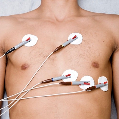 electrocardiograma