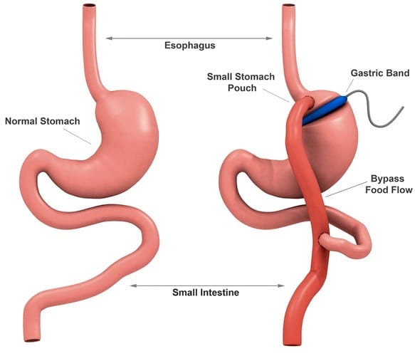 La cirugía bariátrica es más efectiva que la dieta contra la diabetes tipo 2