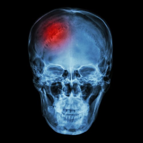 aneurisma-en-el-cerebro