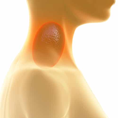 Cáncer del esófago: ¿Cuáles son los factores de riesgo?